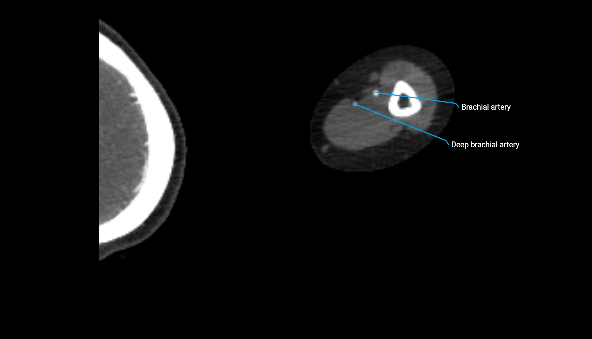 CTA upper limb axial cross sectional anatomy labelled image 219 (2).webp